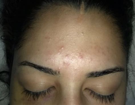 Colorless Bumps On Forehead Beauty Insider Community