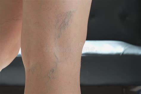 Varicose Veins In The Legs Stock Image Image Of Blood 155515273