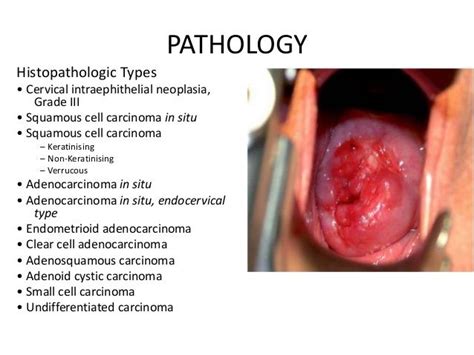 18 Best Squamous Cell Carcinoma Of Cervix Images On Pinterest