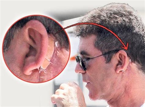 The news comes a day as the agt judge is recuperating from surgery following an accident at his malibu. Celeb-Surgery: Simon Cowell Surgery