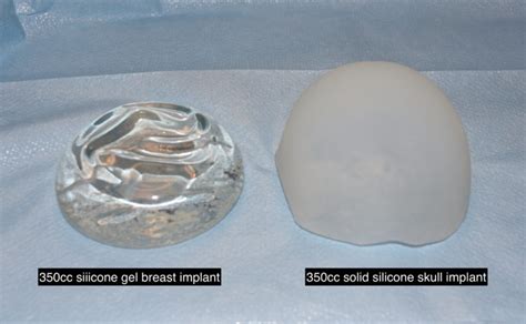 Why A Custom Silicone Skull Implant Is Not Like A Silicone Breast