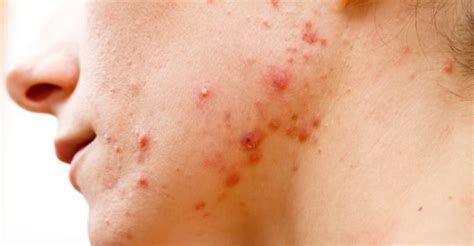 Cystic Acne Symptoms Causes And 20 Natural Treatments Well Being Secrets