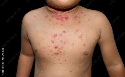 Molluscum Contagiosum Skin Lesions Also Called Water Warts Of Asian