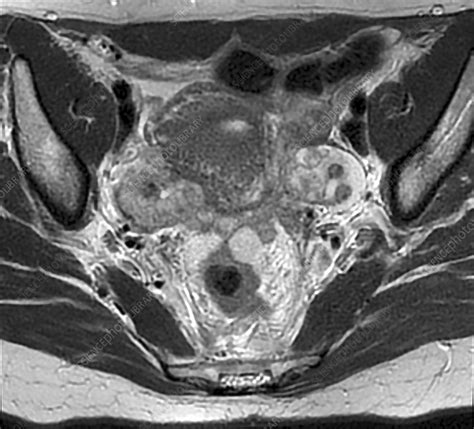 Ovarian Cancer MRI Scan Stock Image C050 9706 Science Photo Library