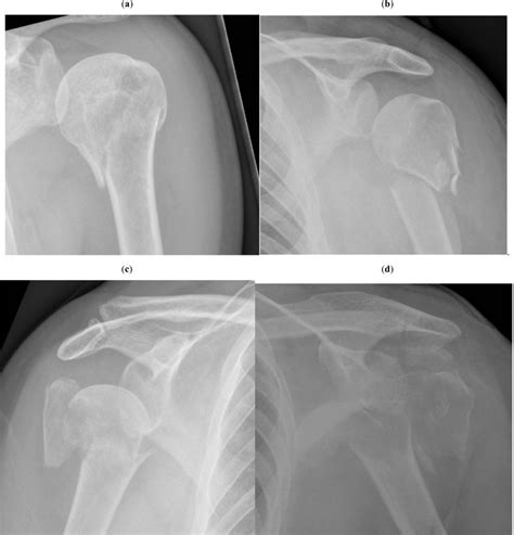 Proximal Humeral Fractures According To Neer Classification A One Part