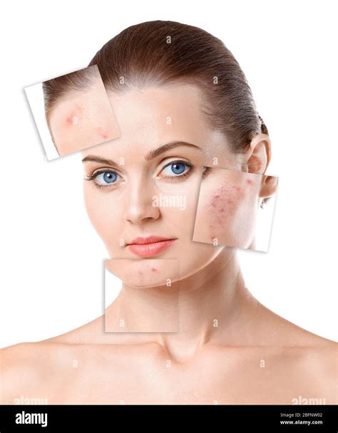 Woman Face Before And After Acne Treatment Procedure Skin Care Concept