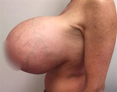 el drama de una estrella porno se implantó 4000 cc de silicona en sus senos y ahora se enfrenta