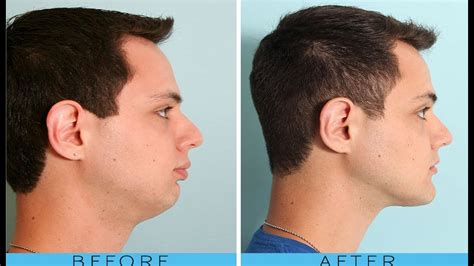 how to get a good jawline and cheekbones 