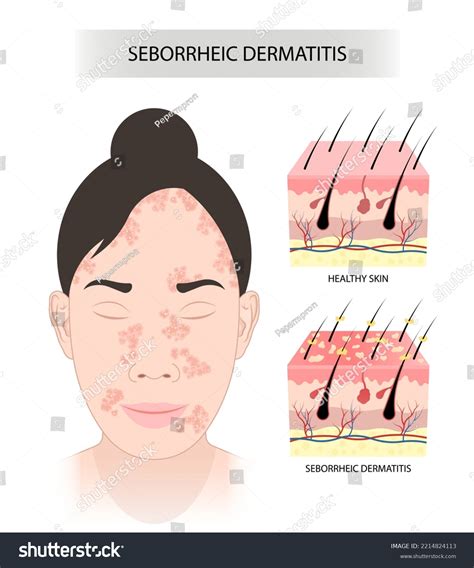 Seborrheic Dermatitis Facial Inflamed Skin Stubborn Stock Vector