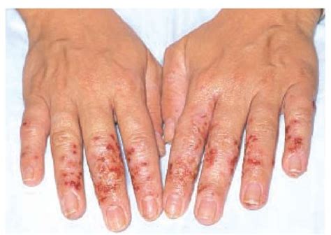 Contact Dermatitis And Related Disorders Part 1