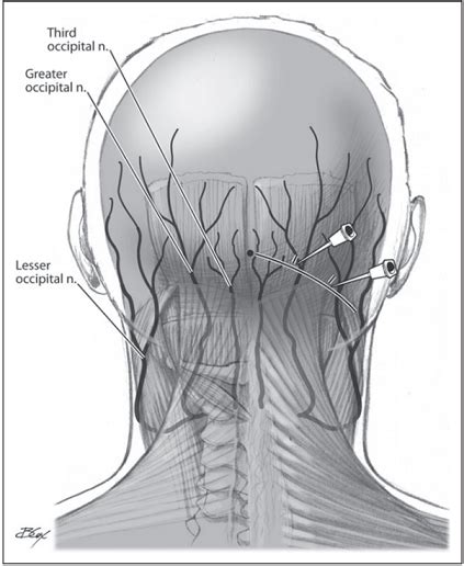 Lesser Occipital Nerve Injection Wikimsk