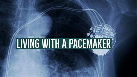 Living With A Pacemaker Pacemaker Lead Extraction 2019 Youtube