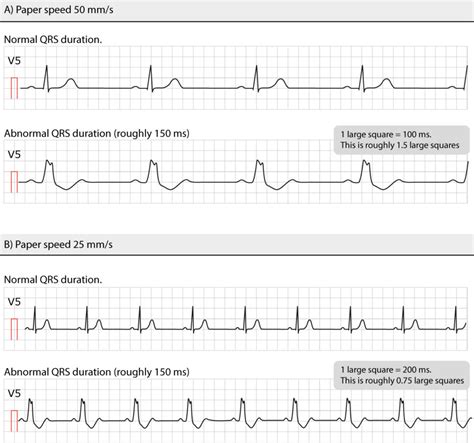 The Qrs Complex Ecg Features Of The Q Wave R Wave S Wave Duration
