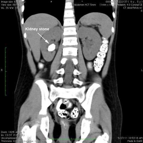 Pediatric Kidney Stone Ct