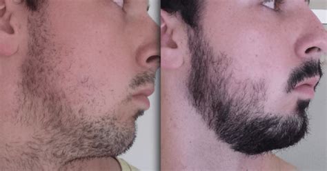 Here are some minoxidil beard before and after results! How Long To Leave Minoxidil On Face? - iManscape