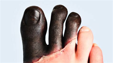 Man Cuts Off Toes To Avoid Waiting List News The Times And The Sunday