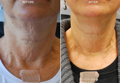 Botox And Dysport Before And After Photos Ny