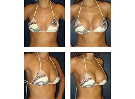 Rapid Recovery Breast Augmentation By Dr Matthew Schulman Nyc Board Certified Plastic Surgeon