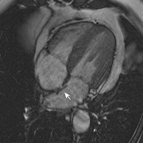 Magnetic Resonance Imaging After Percutaneous Closure Of A Patent