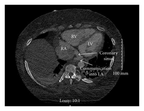 Great cardiac vein shown is actually the blue vein on front/ anterior of heart. Cardiac CTA. The arrows indicate the coronary sinus with a ...