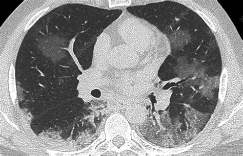 Lungs Affected By Covid 19 Pneumonia Ct Scan Stock Image C0492963