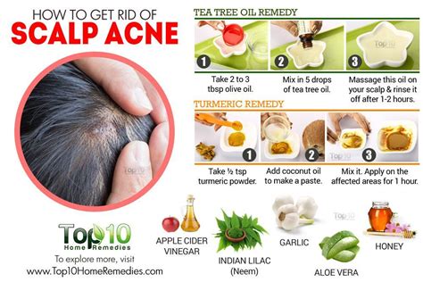 How To Get Rid Of Scalp Acne Diy Pimple Treatment Cystic Acne