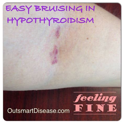 Why Easy Bruising Is So Common In Hypothyroidism Many Hypothyroid And
