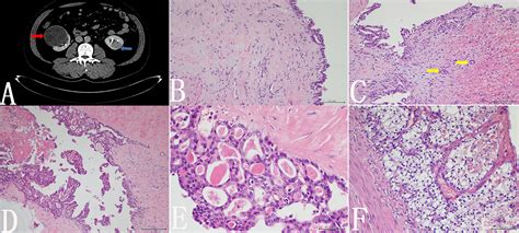 Frontiers Case Report Bilateral Renal Cell Carcinoma With Different