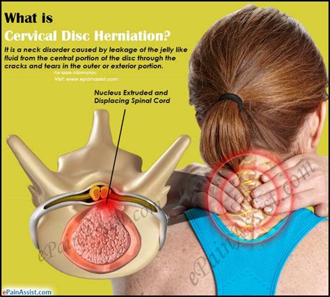 What Is Cervical Disc Herniation How Is It Treated Sexiezpicz Web Porn