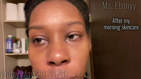 The overgrowth of yeast causes an inflammation on as fungi feed on oils and fatty acids, it is best to avoid these elements altogether. Day 27 | Fungal Acne Journey | Ms. Ebonyy - YouTube