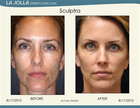 patient treated with sculptra at la jolla cosmetic laser clinic collagen growth laser clinics