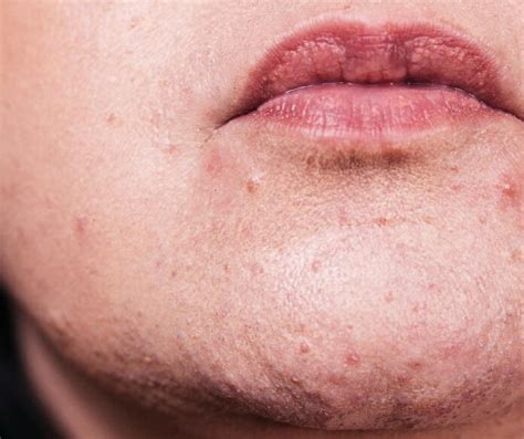 Fordyce Spots On Lips Treatment Healths Digest