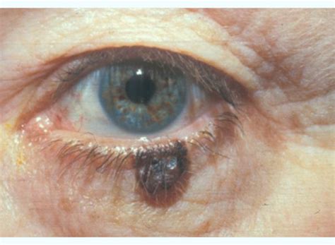 Eyelid Tumours The Dh Verity Eye Practice