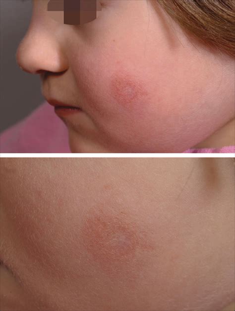 Picture Of The Month—diagnosis Dermatology Jama Pediatrics Jama