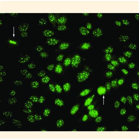 Multiple Nuclear Dot Staining Pattern By Indirect Immunofluorescence On