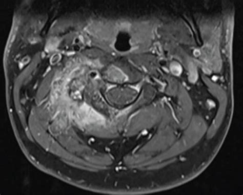 Case 2 Aggressive Osteoblastoma In C3 Ad Ct Scan Reconstructions