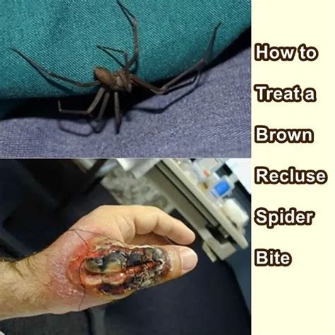 9 Effective Home Remedies To Treat Spider Bites Brown Recluse Spider