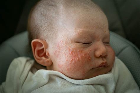 Baby Acne What Parents Need To Know Riverchase Dermatology