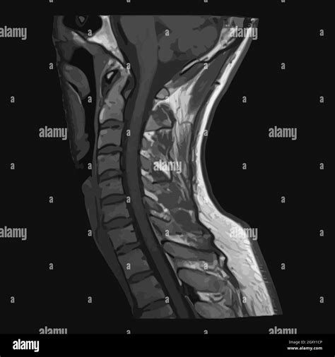 Realistic Image Sagittal Of Cervical Spine With CT Scan MRI Magnetic