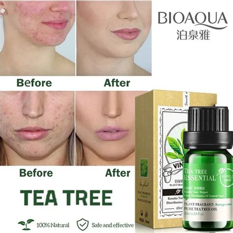 Tree Tea Oil For Acne Scar Removal Cystic Acne Treatment Blackhead