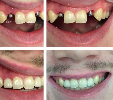 Antes Y Despues Implantes Dentales Y Carillas Dentales De Beauty Dental