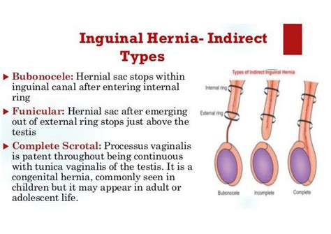 Clinical Classification Of Inguinal Hernias Inguinal Hernias The Best