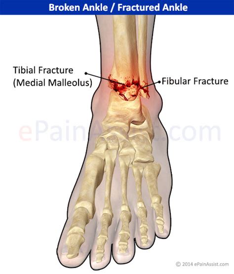 Ankle Joint Fracturetypesclassificationsymptomstreatmentrecovery