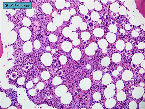 Qiaos Pathology Bone Marrow Biopsy Of Essential Thrombocythemia A