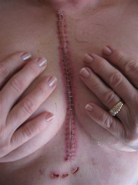 Deformutilation: Surgical Staples