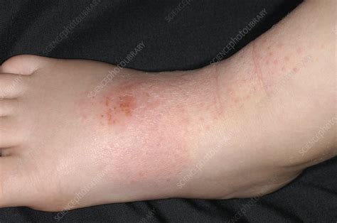 Atopic Eczema Stock Image M1500368 Science Photo Library