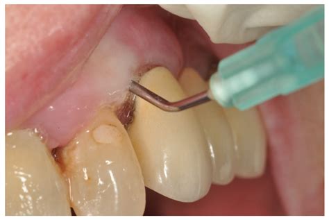 JCM Free Full Text Ozone In Patients With Periodontitis A Clinical