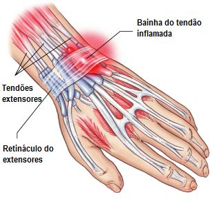 Diferenças entre Tendinite e Tenossinovite Viva Fisio