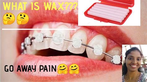 What Is Orthodontics Waxgo Away From Your Braces Ulcersbest Solution In Lock Downhow To