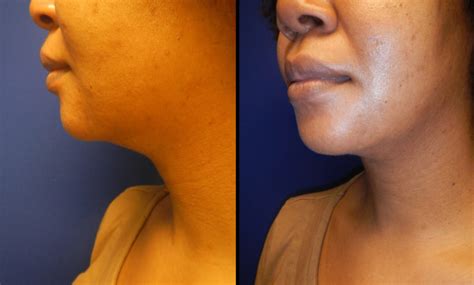 Chin And Neck Contouring Plastic Surgery Group Of Memphis